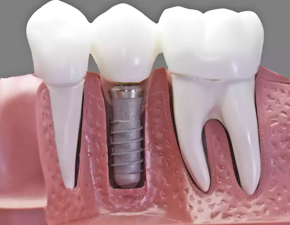 Most Common Myths About Dental Implants 8 myths about dental implants
