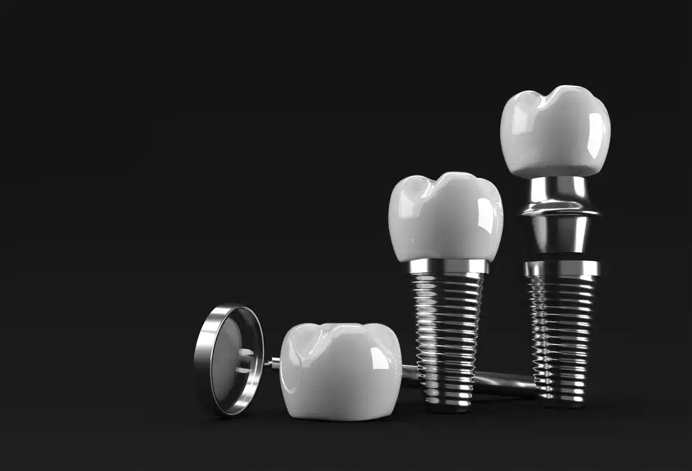 What to Expect When Getting an Implant 8 getting an implant