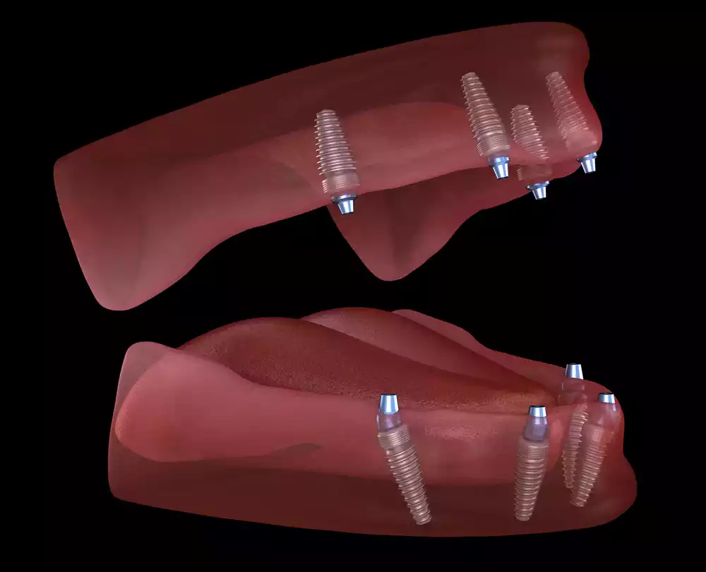 All On x Implants in Tijuana 3 All on X (1)