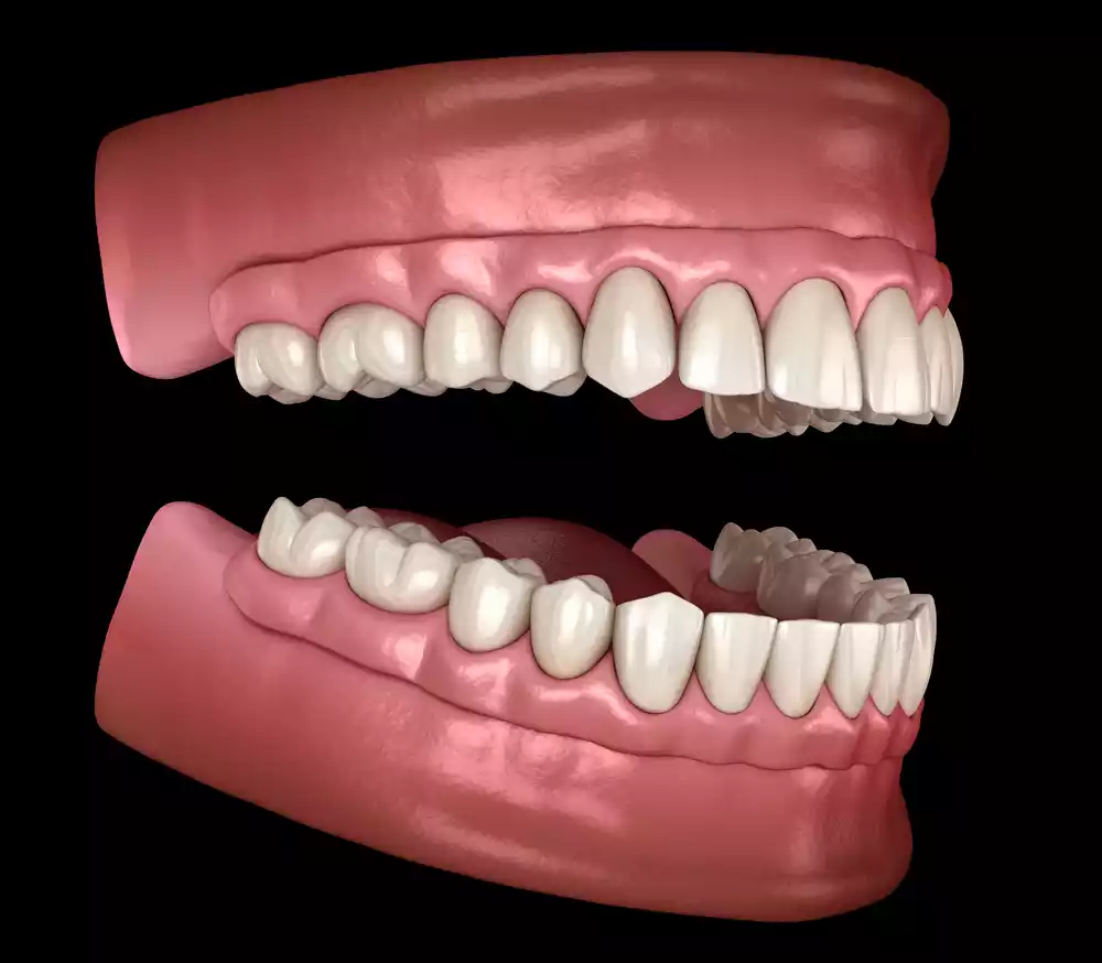 All On x Implants in Tijuana 4 All on X (2)