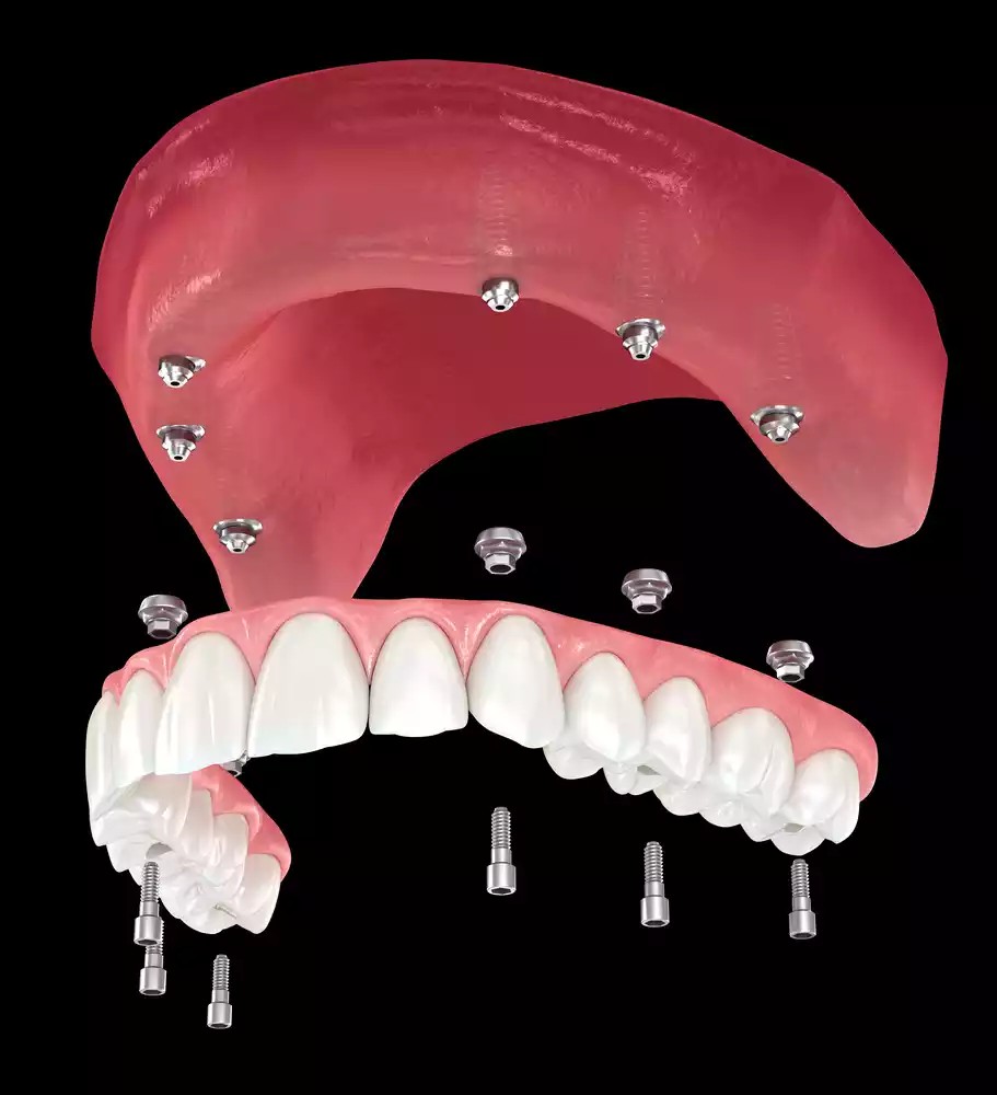All On 6 Implants In Tijuana 3 all on 6 implants in Tijuana