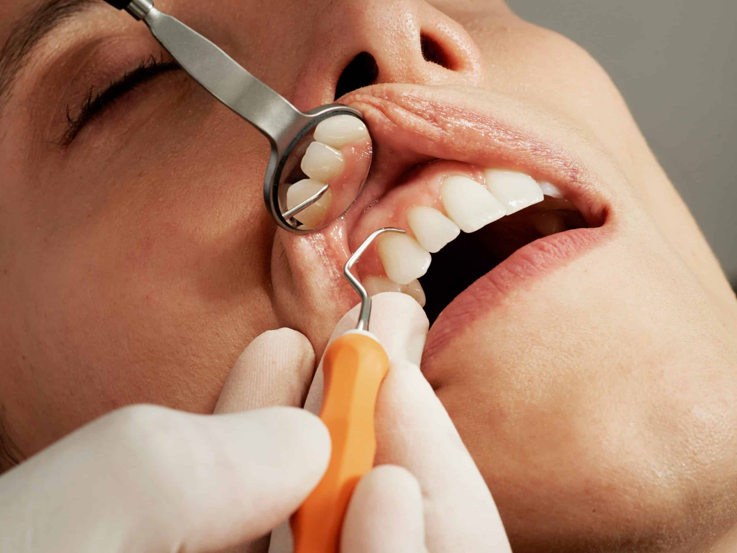 early signs of gum disease