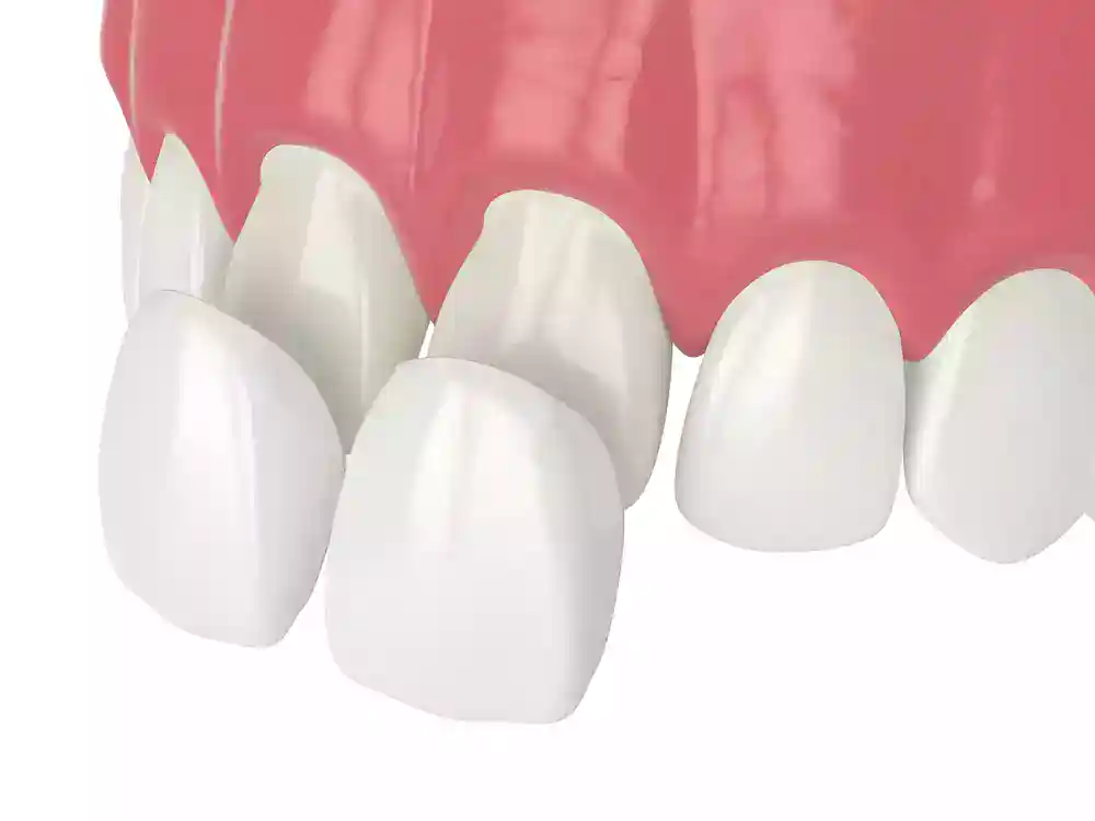 Composite Veneers 2121