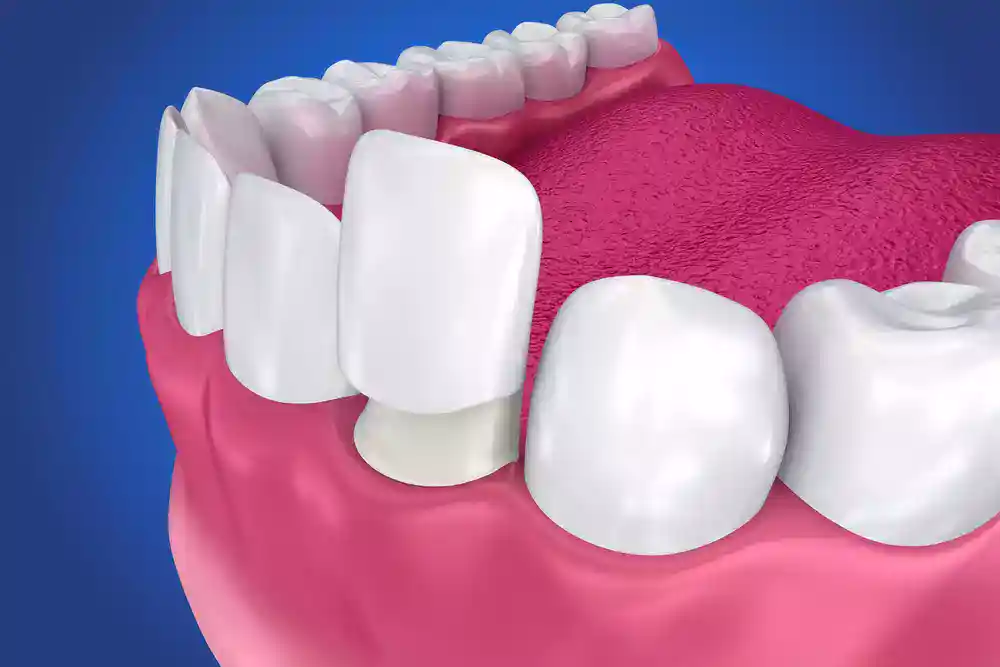 Porcelain Veneers 2121