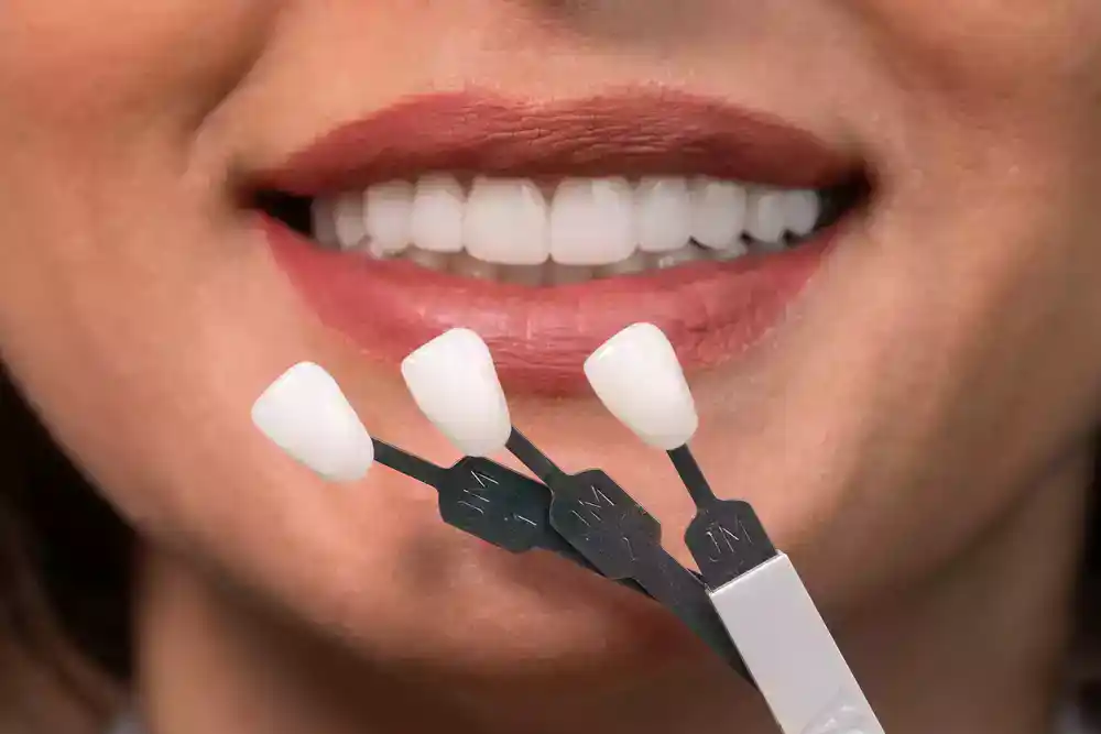 veneers