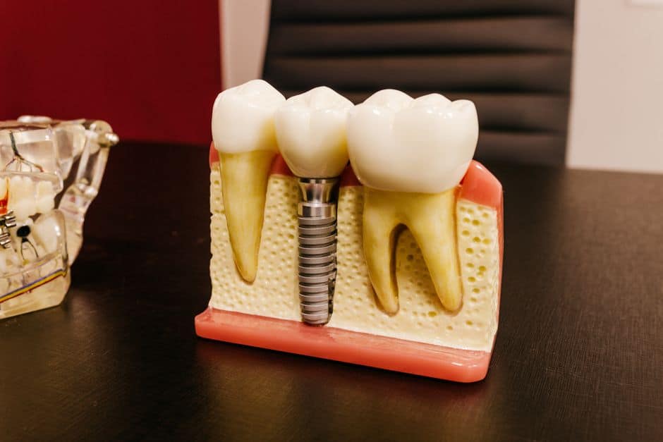dental implant healing stages